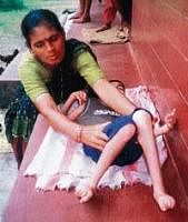 A mother taking care of her endosulfan-affected child. dh photo