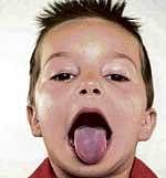 Pale tongue, a sign of anaemia?