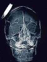 The CAT scan of the Afghan soldier who had an improvised bomb lodged in his head. NYT