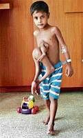 Deepak with his parasite twin which was surgically removed.