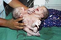 The male conjoined twins born at Tumkur hospital. DH photo