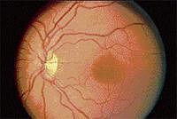 Centre urged  to allow Bionic Eye trial