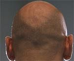 Coming soon: A cure for baldness?