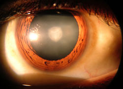 Magnified view of cataract in human eye, seen on examination with a slit lamp using diffuse illumination.Wiki Image