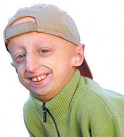 Drug that helps treat progeria