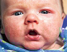 cause of eczema found