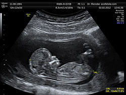 Ultrasound image of the fetus at 12 weeks of pregnancy in a sagittal scan. Wikipedia image