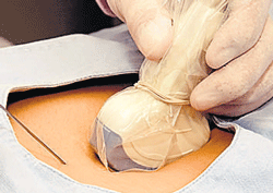 Ultrasonic needle  to be developed
