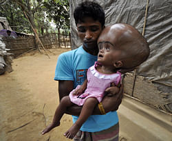 Indian daily labourer, Abdul Rahman, 26, holds his 18 month old daughter, Roona Begum, suffering from Hydrocephalus,a buildup of fluid inside the skull that leads to brain swelling, in front of their home in Jirania village on the outskirts of Agartala, the capital of northeastern state of Tripura on April 12, 2013. Rahman works in a brick factory earning 150 rupees (2.75 USD) a day and does not have the capability to treat his daughter. India's rural development minister said in November 2012, that the country's public health system had 'collapsed' in a blunt assessment of his government's failure to extend a social safety net for the poor. AFP PHOTO