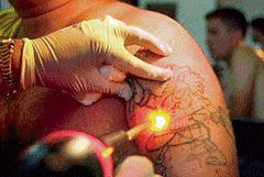 With a change of heart, youngsters turn to dermatologists to get rid of their tattoos.
