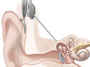Scientists 'print' 3D bionic ear