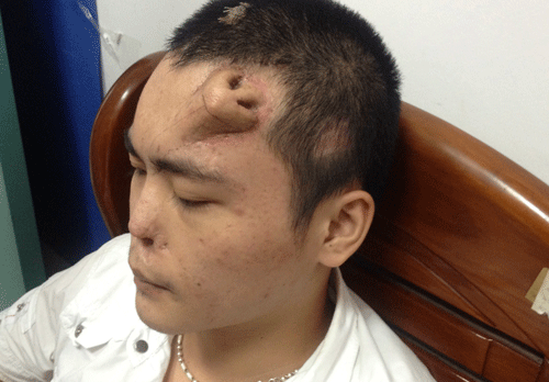 A new nose, grown by surgeons on Xiaolian's forehead, is pictured before being transplanted to replace the original nose, which is infected and deformed, at a hospital in Fuzhou, Fujian province.  Xiaolian, 22, neglected his nasal trauma following a traffic accident on August, 2012. After several months, the infection had corroded the cartilage of the nose, making it impossible for surgeons to fix it leaving no alternative but to grow a new nose for replacement. The new nose is grown by placing a skin tissue expander onto Xiaolian's forehead, cutting it into the shape of a nose and planting a cartilage taken from his ribs. The surgeons said that the new nose is in good shape and the transplant surgery could be performed soon, local media reported. Picture taken September 24, 2013. REUTERS