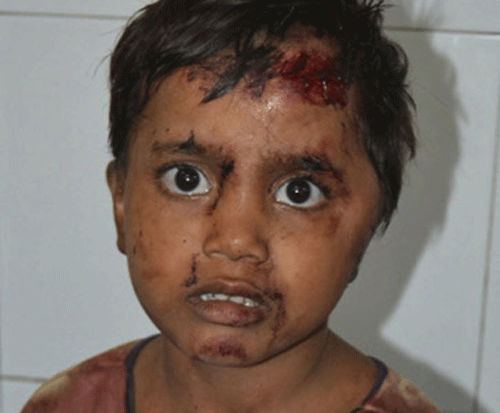 An unidentified girl injured in communal clashes awaits treatment at the district hospital at Muzaffarnagar. AP File Photo