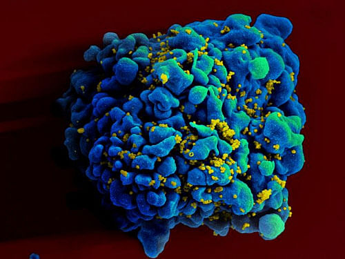 This April 12, 2011 electron microscope image made available by the National Institute of Allergy and Infectious Diseases shows an H9 T cell, colored in blue, infected with the human immunodeficiency virus (HIV), yellow. (AP Photo/NIAID)