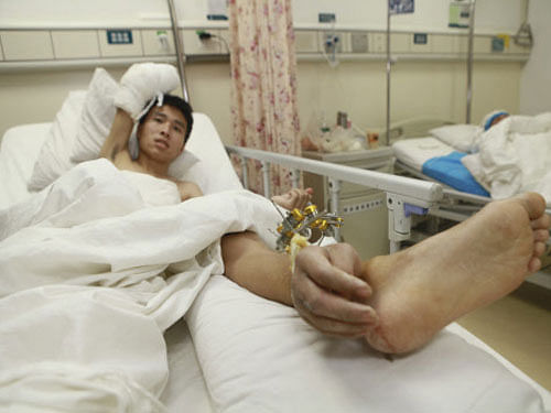 Handout photo of Xiao Wei's severed right hand seen attached to his ankle before undergoing the reattachment surgery at Xiangya Hospital in Changsha, China. Reuters.