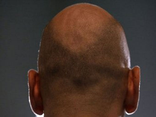 Researchers from the Columbia University have restored hair in patients suffering from alopecia areata - a common autoimmune disease that causes hair loss. Reuters file photo. For representation purpose