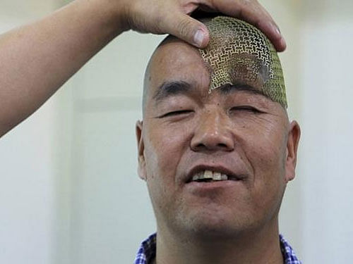A Chinese man whose skull was severely injured in an accident has had fractured bones rebuilt with the help of 3D printing technology. Reuters photo