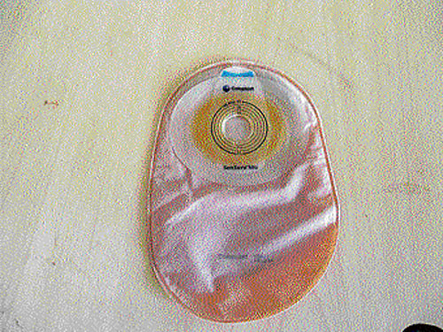 Free distribution of 'surplus' stoma bags from the United Kingdom