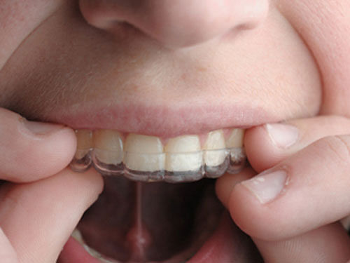 As the regular metallic dental aligners look unaesthetic on the face, patients now have the option of using transparent teeth aligners. Photo Courtesy wikipaedia