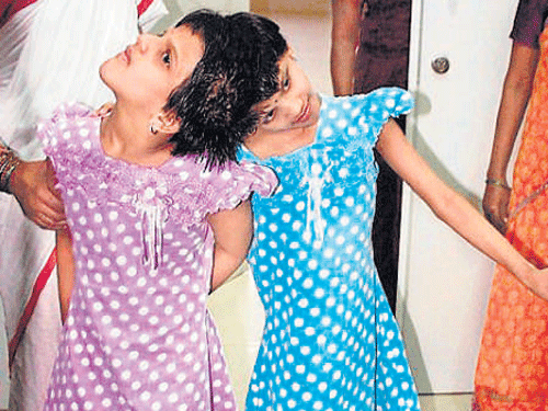 A team of doctors from the UK's Great Ormond Street Hospital   have finally given the nod to separate conjoined sisters Veena and Vani, who have been living in Niloufer Children's Hospital here for almost nine years. DH photo