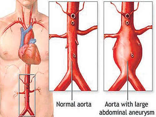 Around 15,000 deaths in the world are caused by aortic aneurysm. Dr NN Khanna shares information about this majorly asymptomatic disease and the remedial procedures.