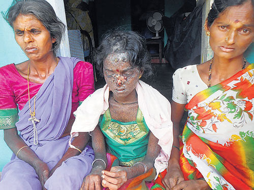 Rajeshwari (centre), a resident of Kurattihosur, near Hanur, who suffers from a mysterious disease. DH PHOTO
