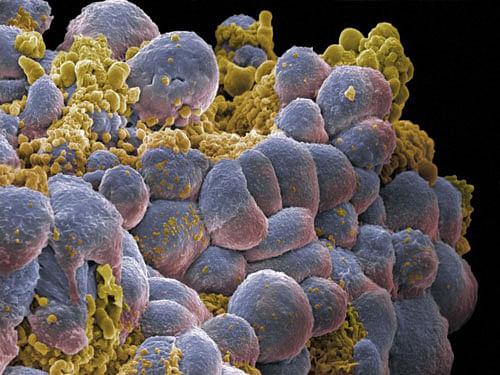 Breast cancer cells. Wellcome Image for representation only