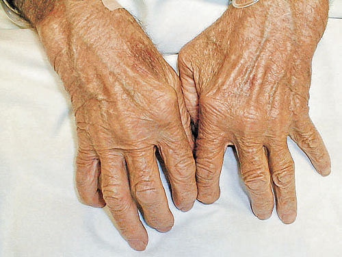 At least 60 per cent of the patients suffering from arthritis are women, City doctors said on Monday.