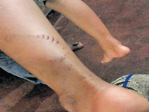 The injuries sustained by Saakshath when he kicked free of a python in Hiriyadka, Udupi district.