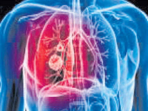 Lung cancer on the rise among women, say doctors