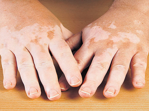 Busting myths about vitiligo