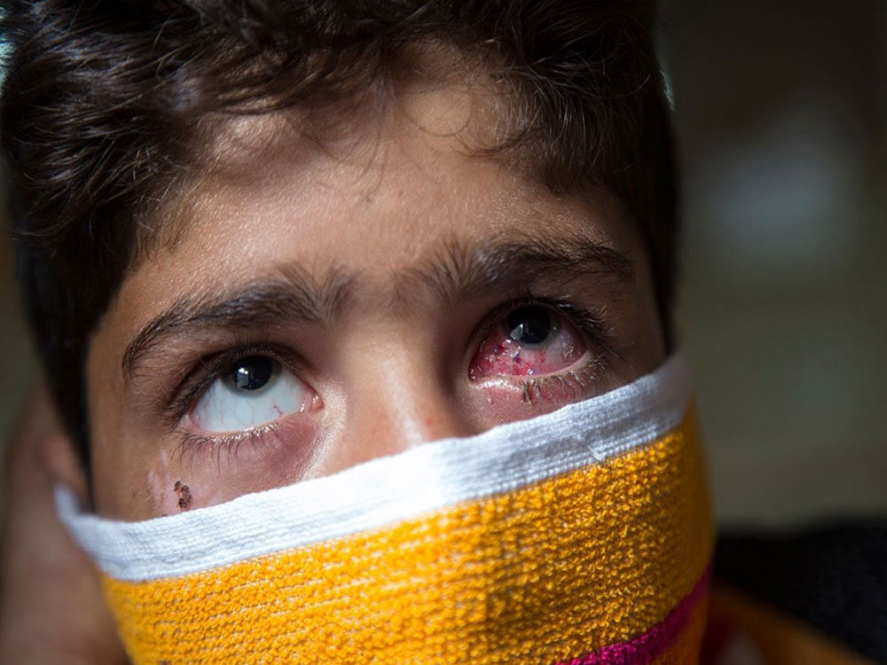 At least a dozen patients in the ward face the dreadful possibility of blindness as a result of the pellet injuries. Image: Twitter