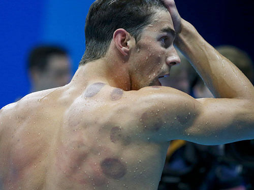 Michael Phelps (USA) of USA is seen with red cupping marks on his shoulder as he competes. REUTERS