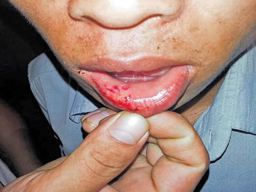 The victim, Thangpimang Kipgen, shows his injuries. DH photo