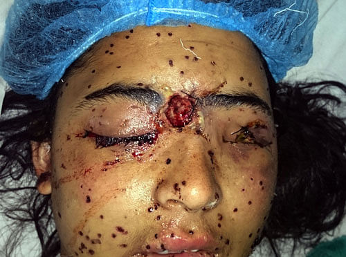 Shakeela Begum of north Kashmir's Baramulla district, was looking for her five-year-old son when the pellets pierced both her eyes on Friday. pti file photo