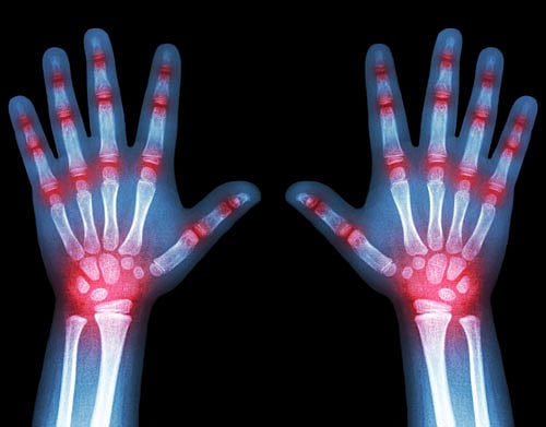 Do your joints hurt?