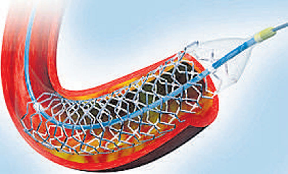 A coronary stent is a tube-shaped device placed in the arteries that supplies blood to the heart. It keeps the arteries open in the treatment of coronary heart diseases.