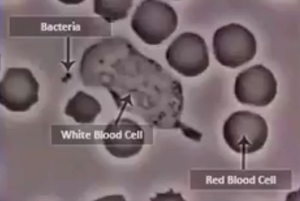 Leukemia is a tumour of the blood that is caused when the production of white blood cells, which are generally part of the body's defence mechanism, increases erratically. Twitter/SahilDictator.