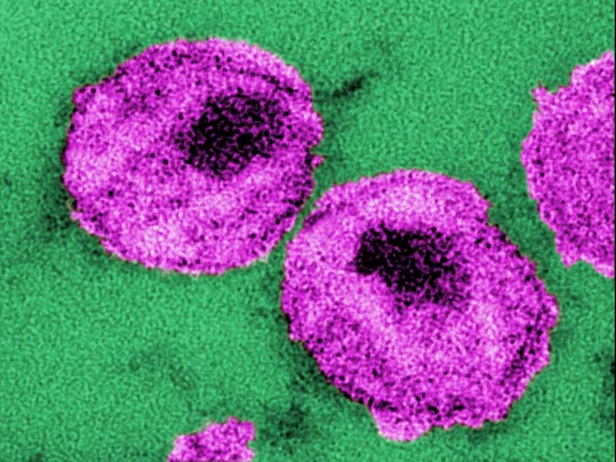 When HIV has inserted itself into a host cell, it forces the cell to make membranes filled with the virus to propagate to other cells. Photo: CDC.
