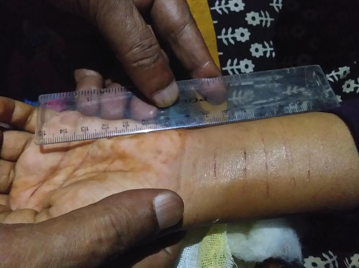 The injury marks on the hand of Kavya Chandrashekar Naika.