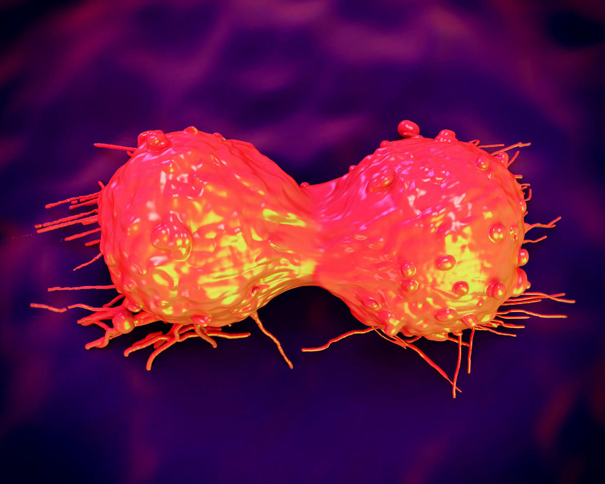 The study has shown that cancerous cells (in pic) in cervical cancer patients can be suppressed with anti-estrogen drugs.