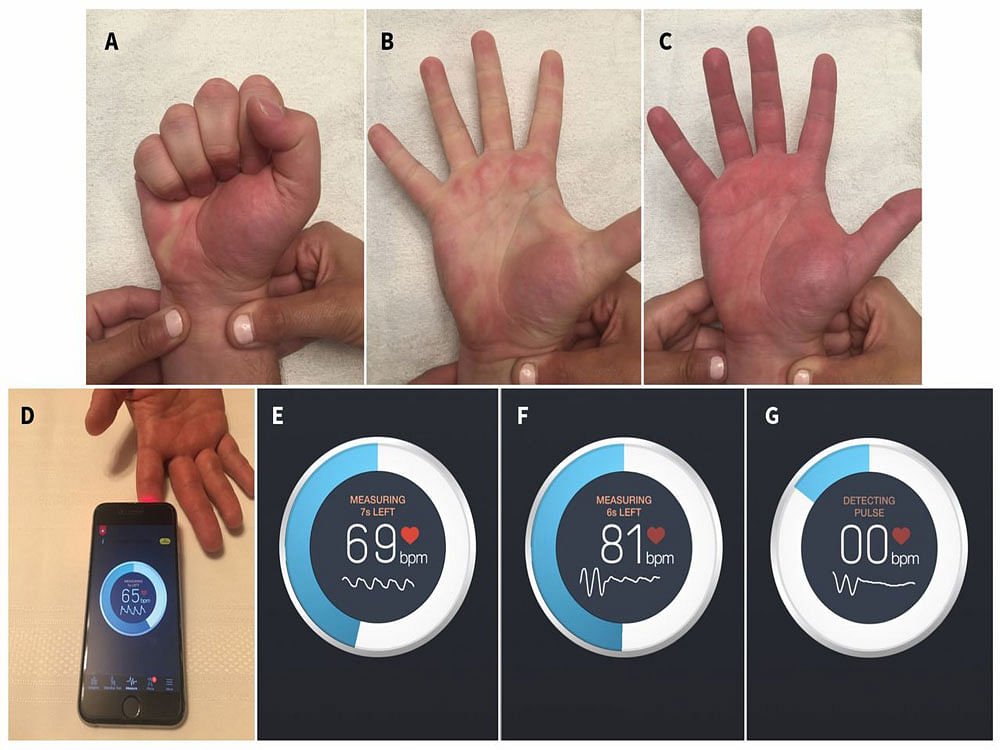 'Smartphone app better at measuring blood flow'