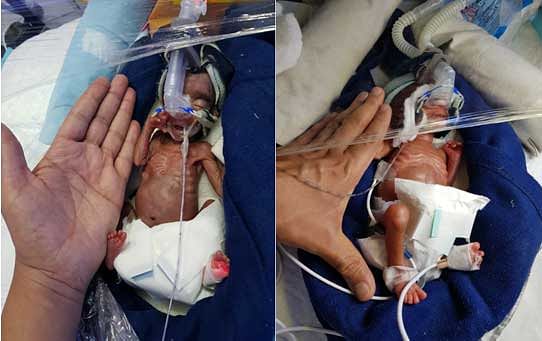 The twin baby boys who weighed around 475 and 617 grams. (DH Photo)