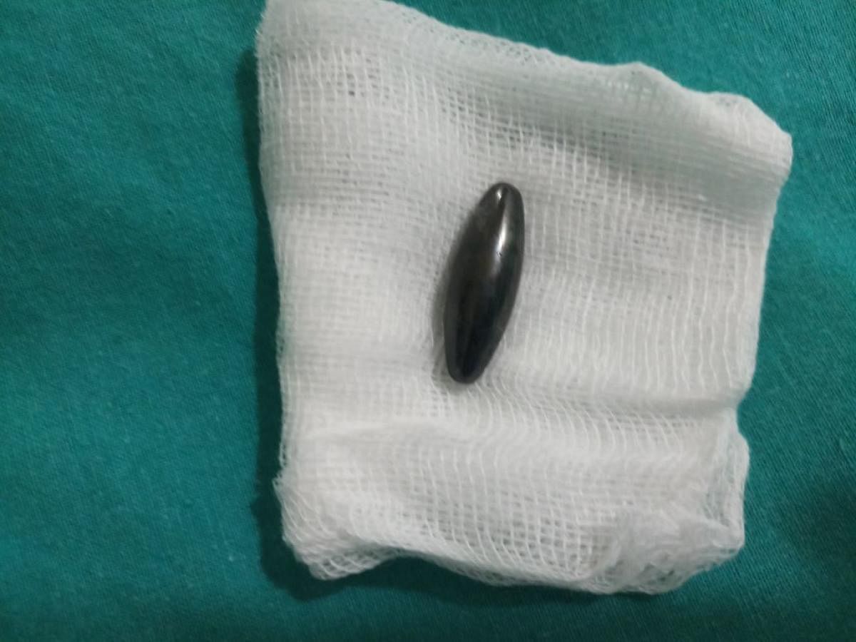 The magnet, which was accidentally swallowed by a child and later successfully removed by the doctors.