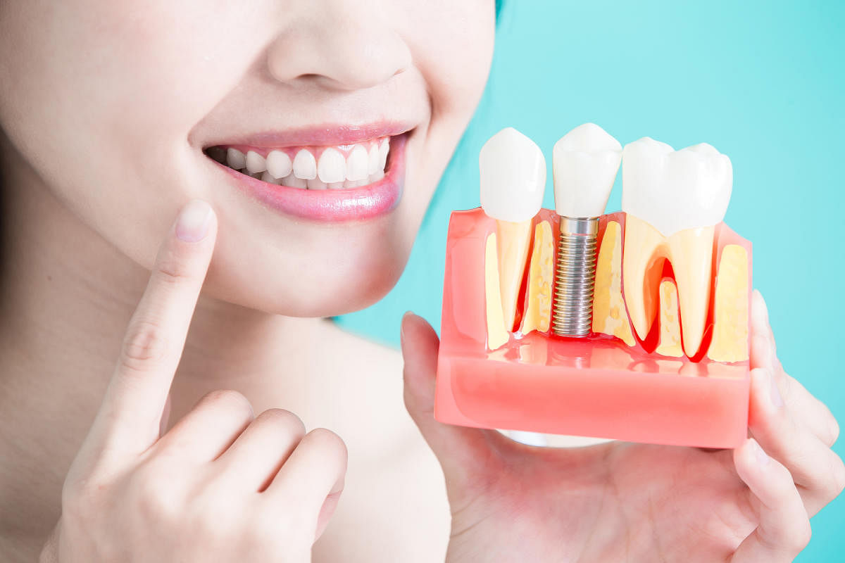 Dental implants are titanium root-like foundations that are placed in strategic positions in the jawbone.