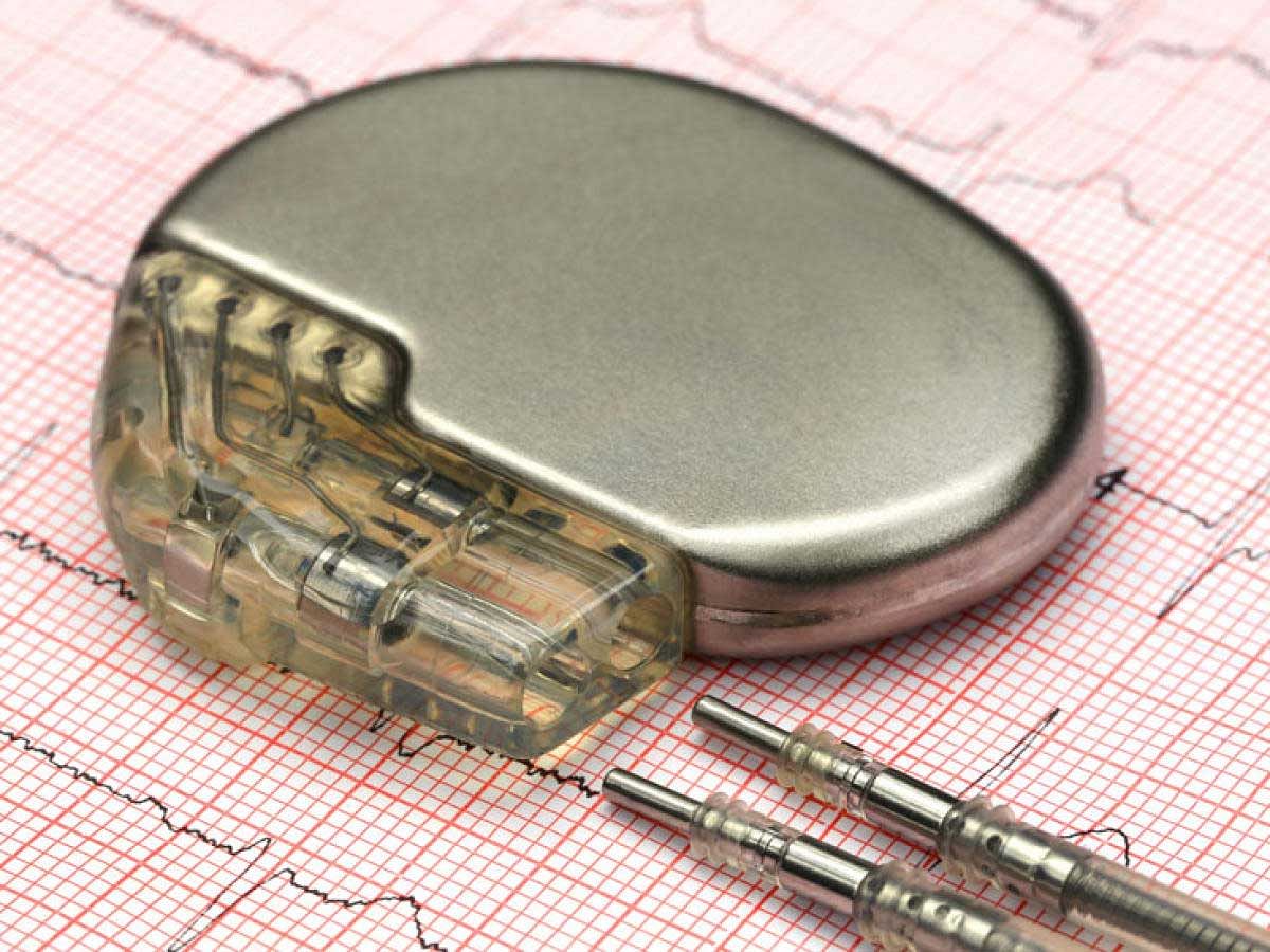 Conventional pacemakers are surgically placed under the skin of the patient with the help of wires stretching from veins on the arms to the heart, which can further cause complications. (Image for representation)