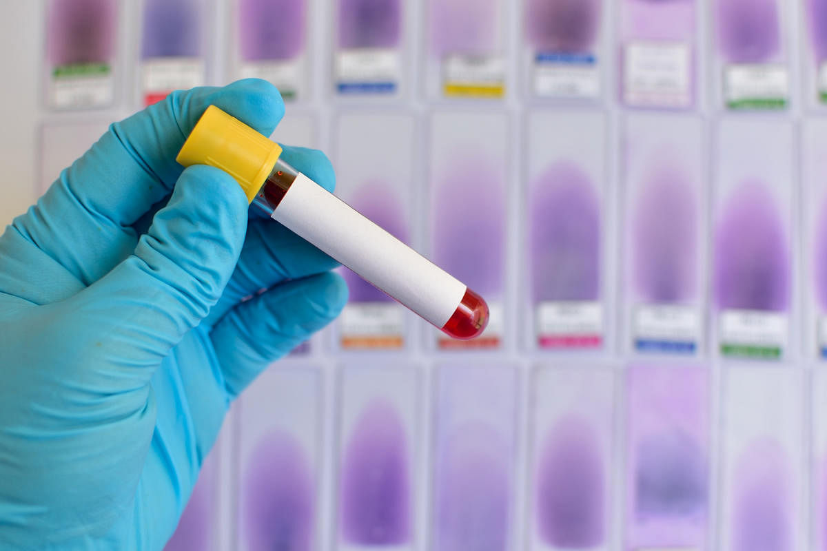 Currently the rates for diagnostic tests vary widely between different pathological laboratories, the same simple blood sugar test can cost anywhere between Rs 25 to Rs 250 depending on the laboratory. Representative image.