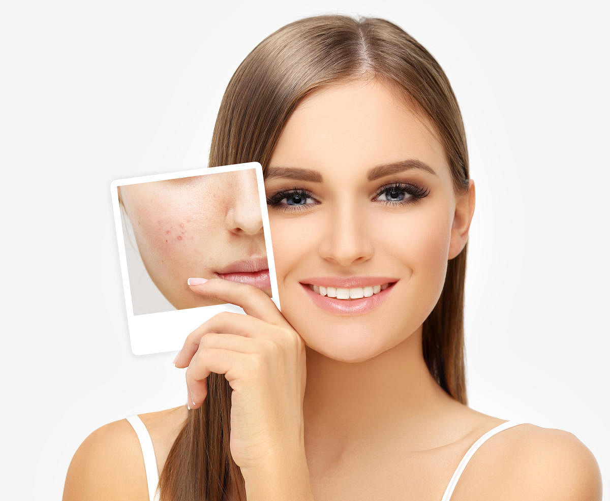 Spot treatment works really well when you have a few acne marks you would like to get rid of.