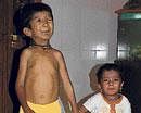 rare disease  Two children suffering from Progeria in Guledagudda, Badami taluk in Bagalkot. DH photo