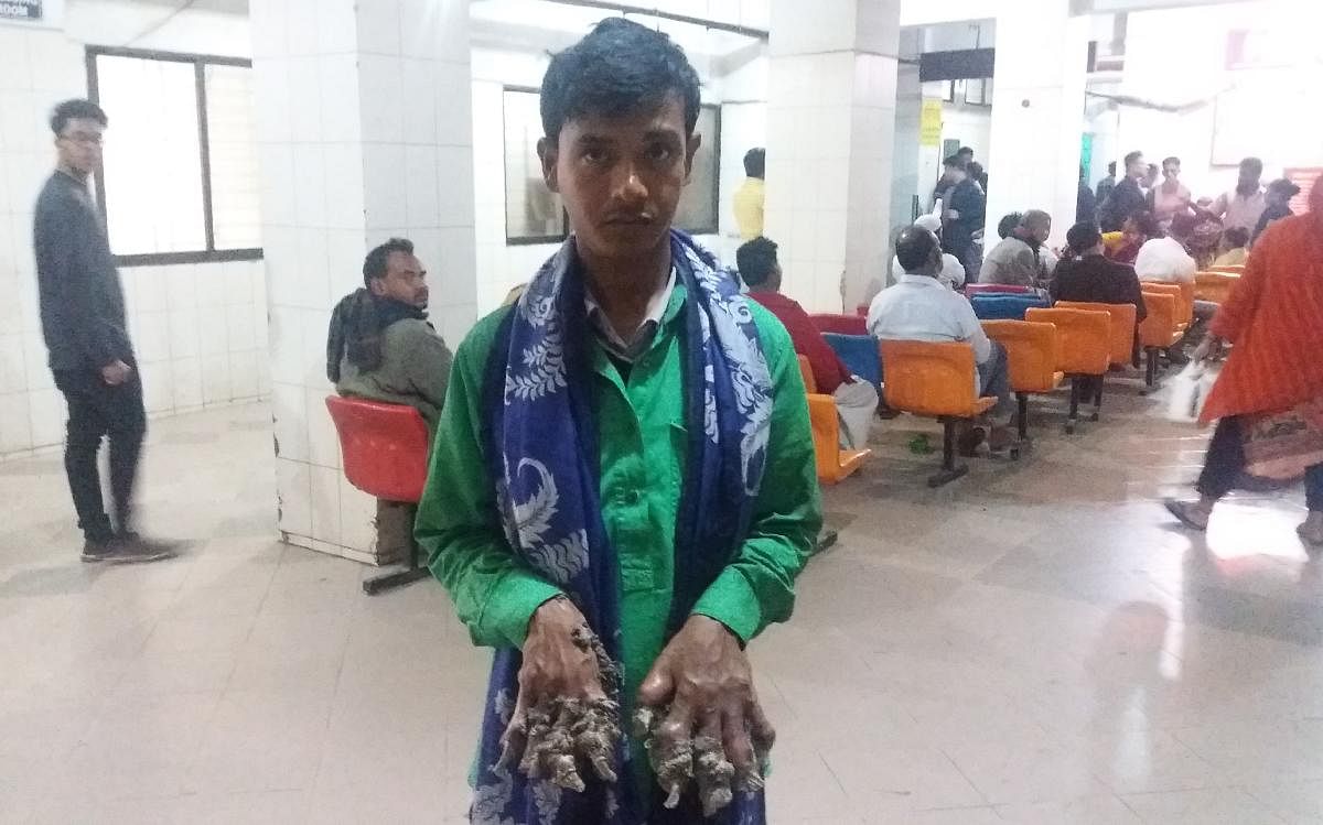 Abul Bajandar (C), dubbed as Bangladeshi tree man, returns to a Dhaka hospital on January 21, 2019, as bark-like growths on his hand keep increasing. - A Bangladeshi father dubbed "Tree Man" for the bark-like growths on his body returned to hospital on Ja